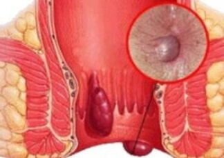 How they look hemorrhoids